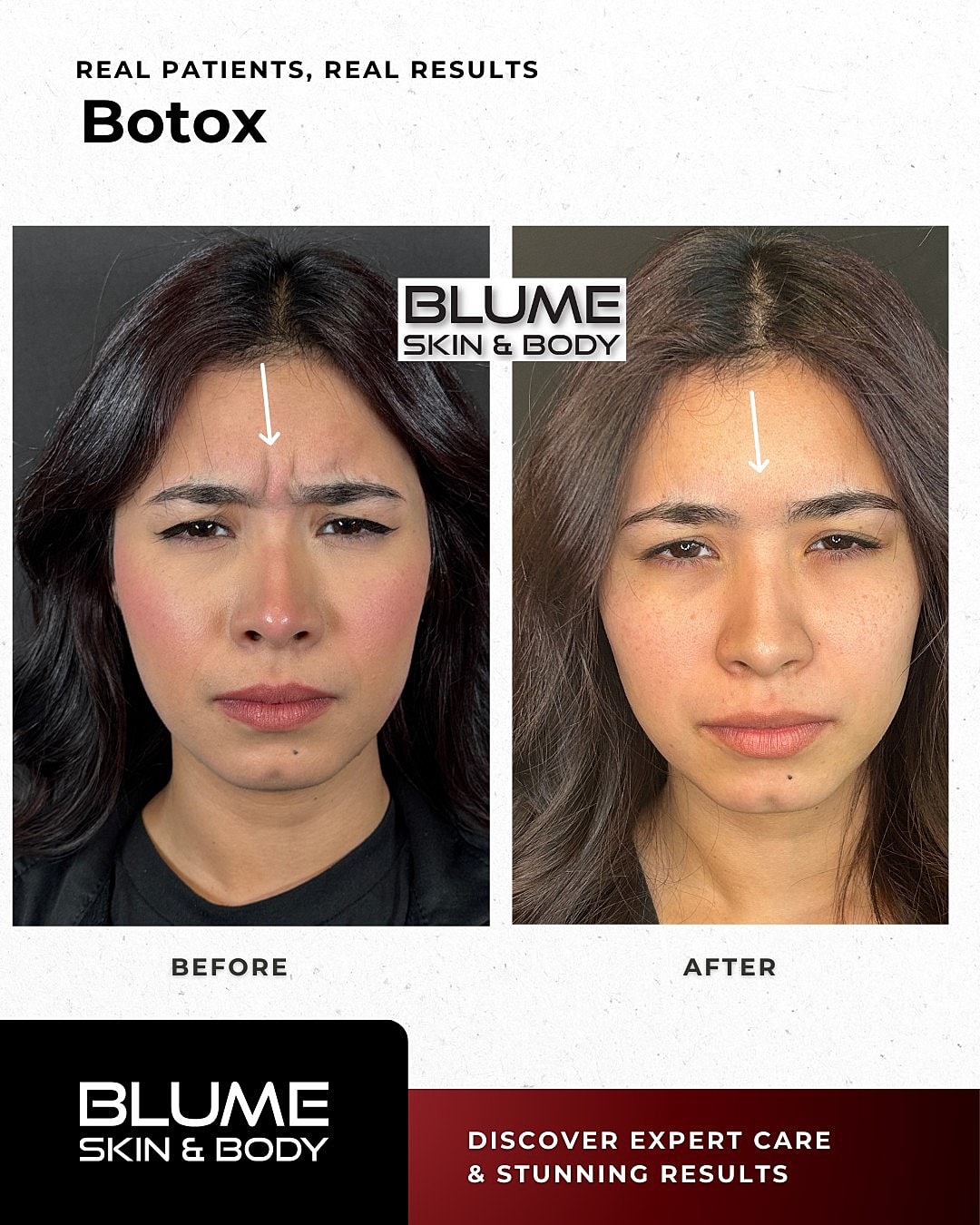 Botox Before & After