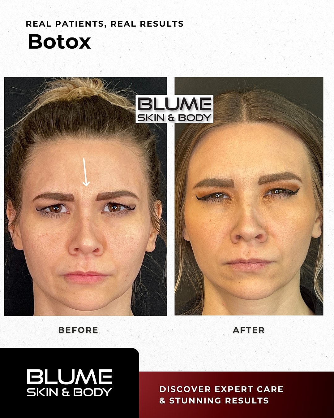 Botox Before & After