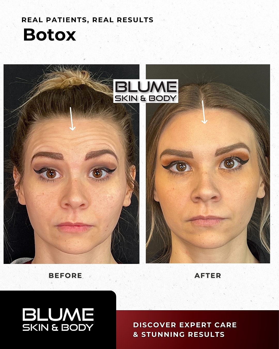 Botox Before & After