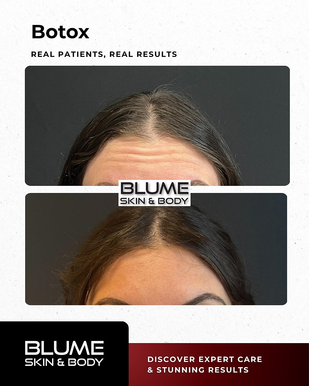 Botox treatment before and after results.