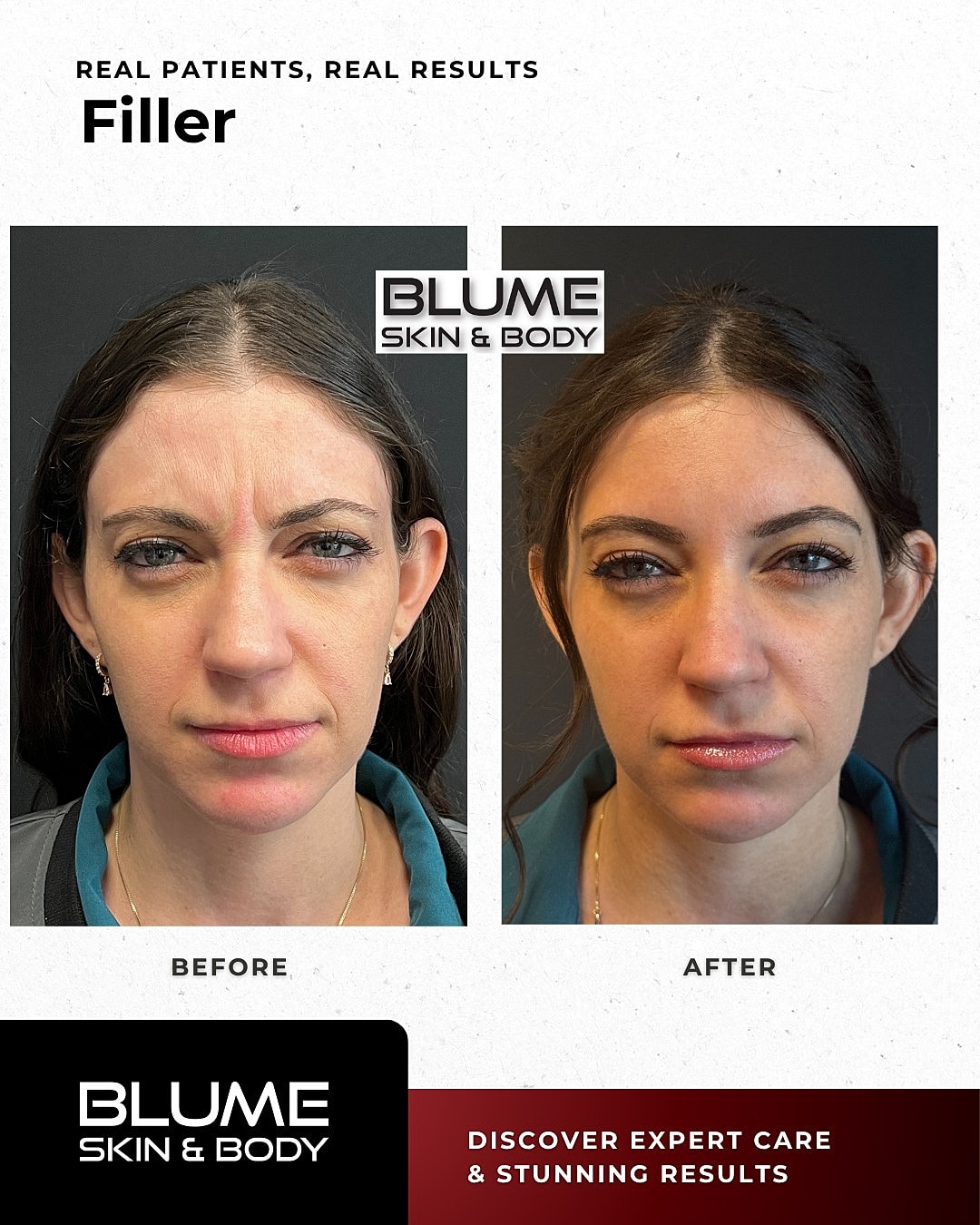 Before and after filler treatment comparison