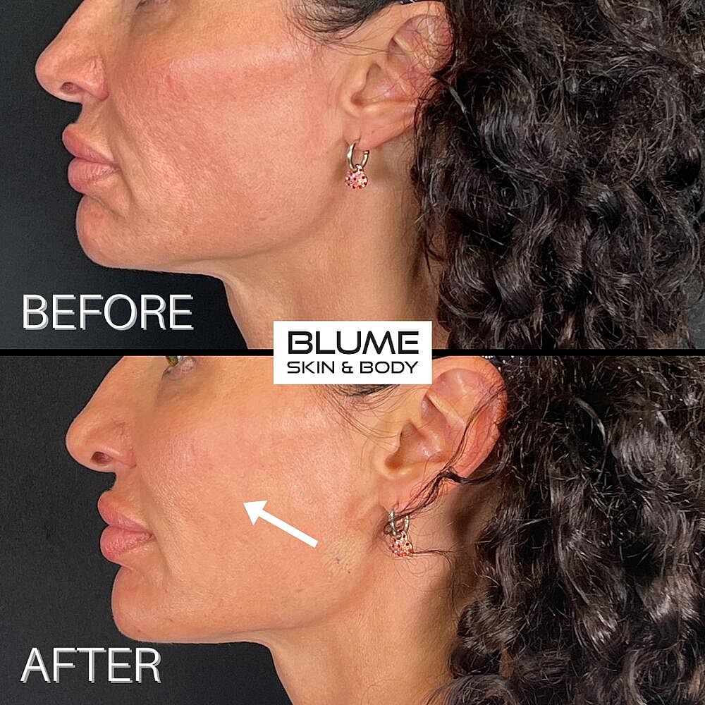 Dermal Fillers Before & After