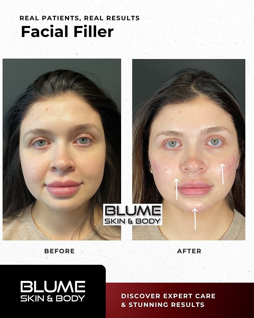 Before and after facial filler treatment comparison