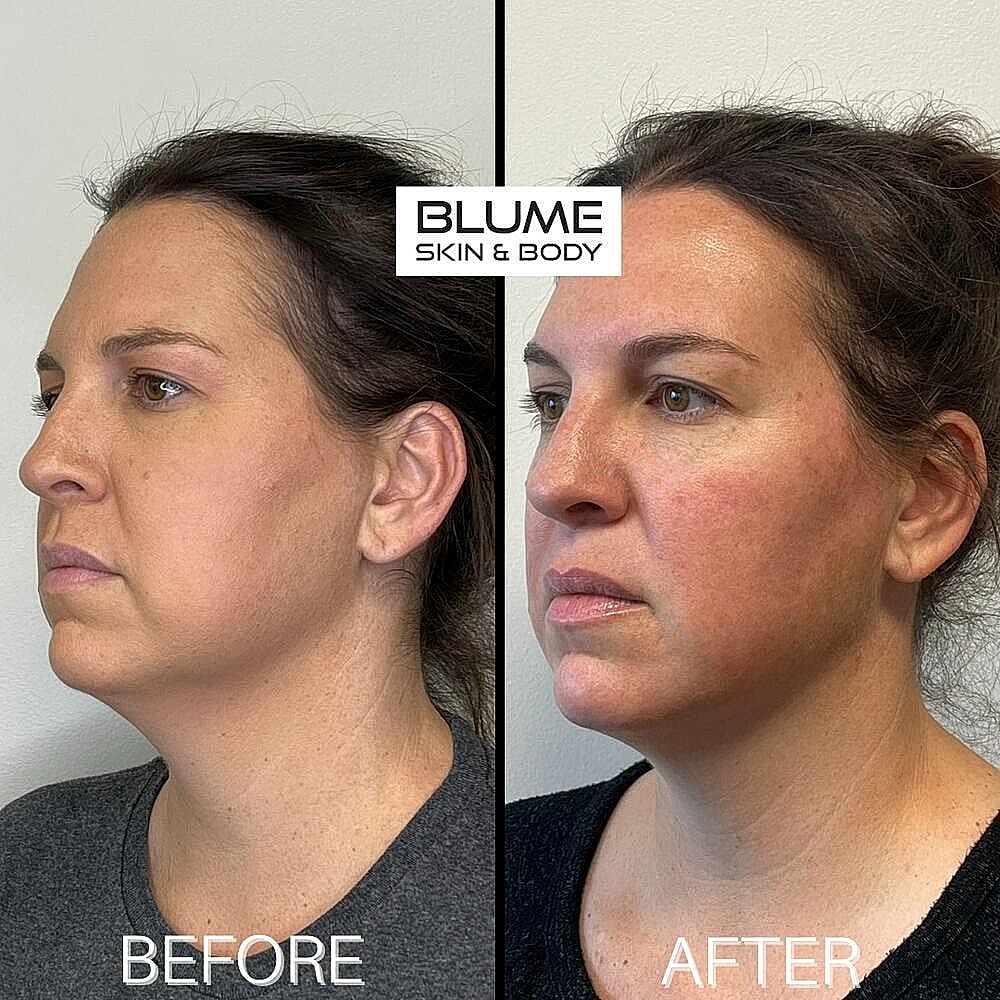 Dermal Fillers Before & After