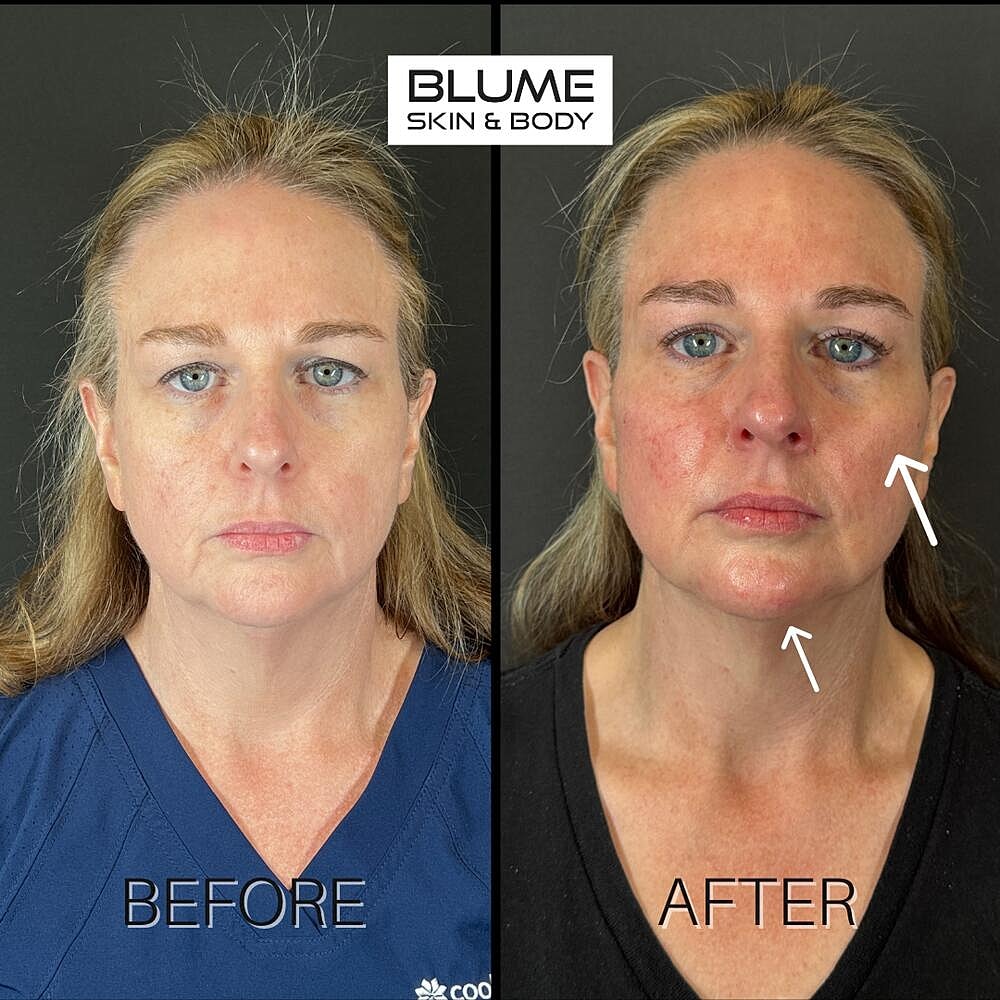 Dermal Fillers Before & After