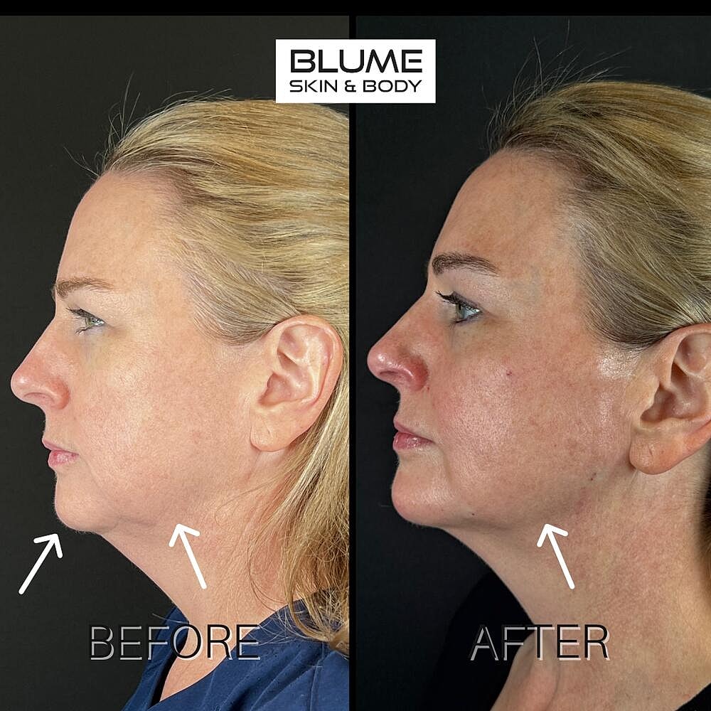 Dermal Fillers Before & After