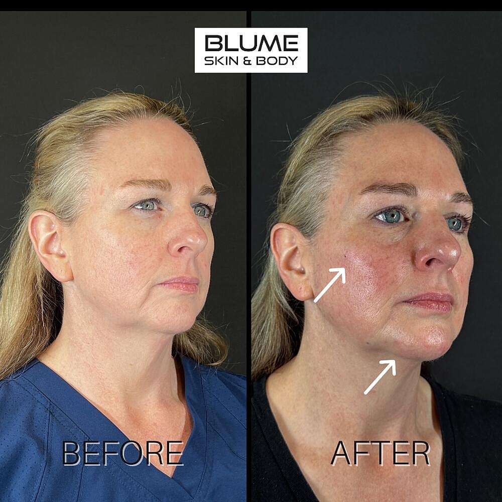 Dermal Fillers Before & After