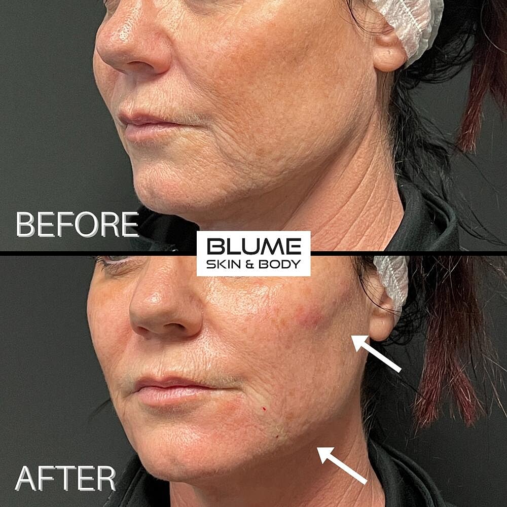 Dermal Fillers Before & After