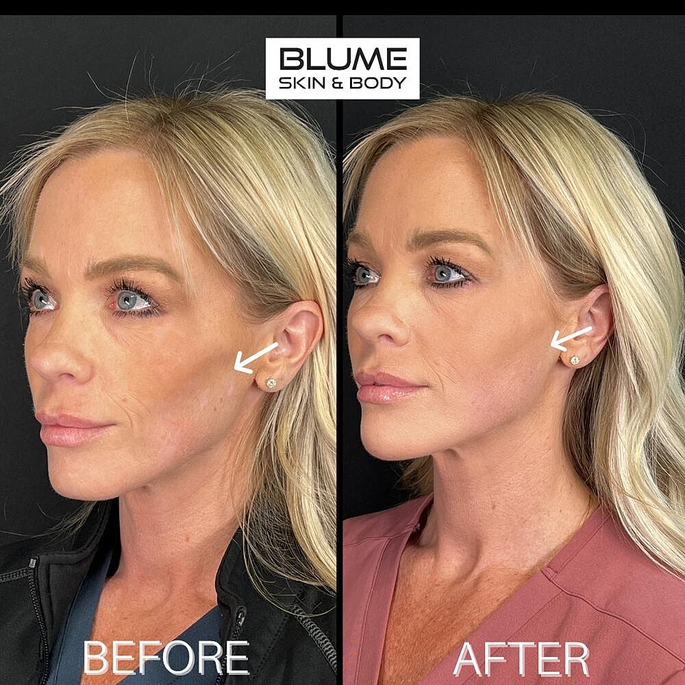 Dermal Fillers Before & After