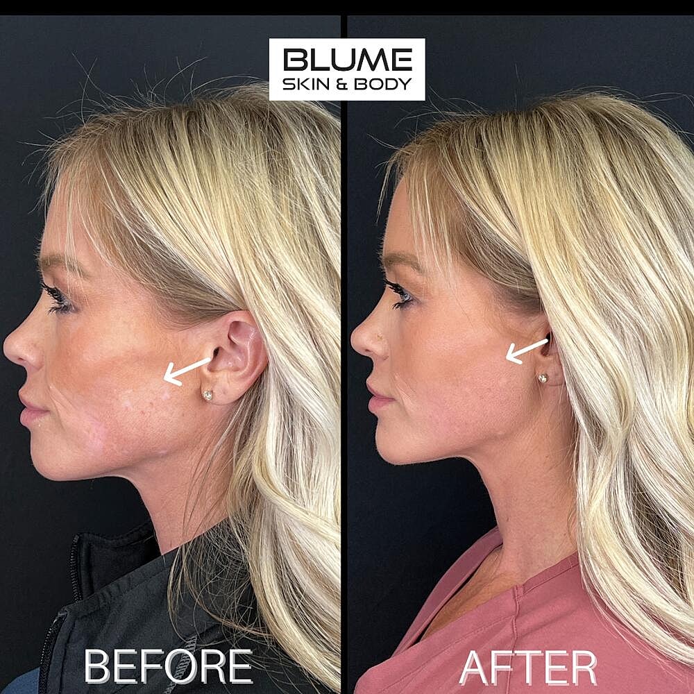 Dermal Fillers Before & After