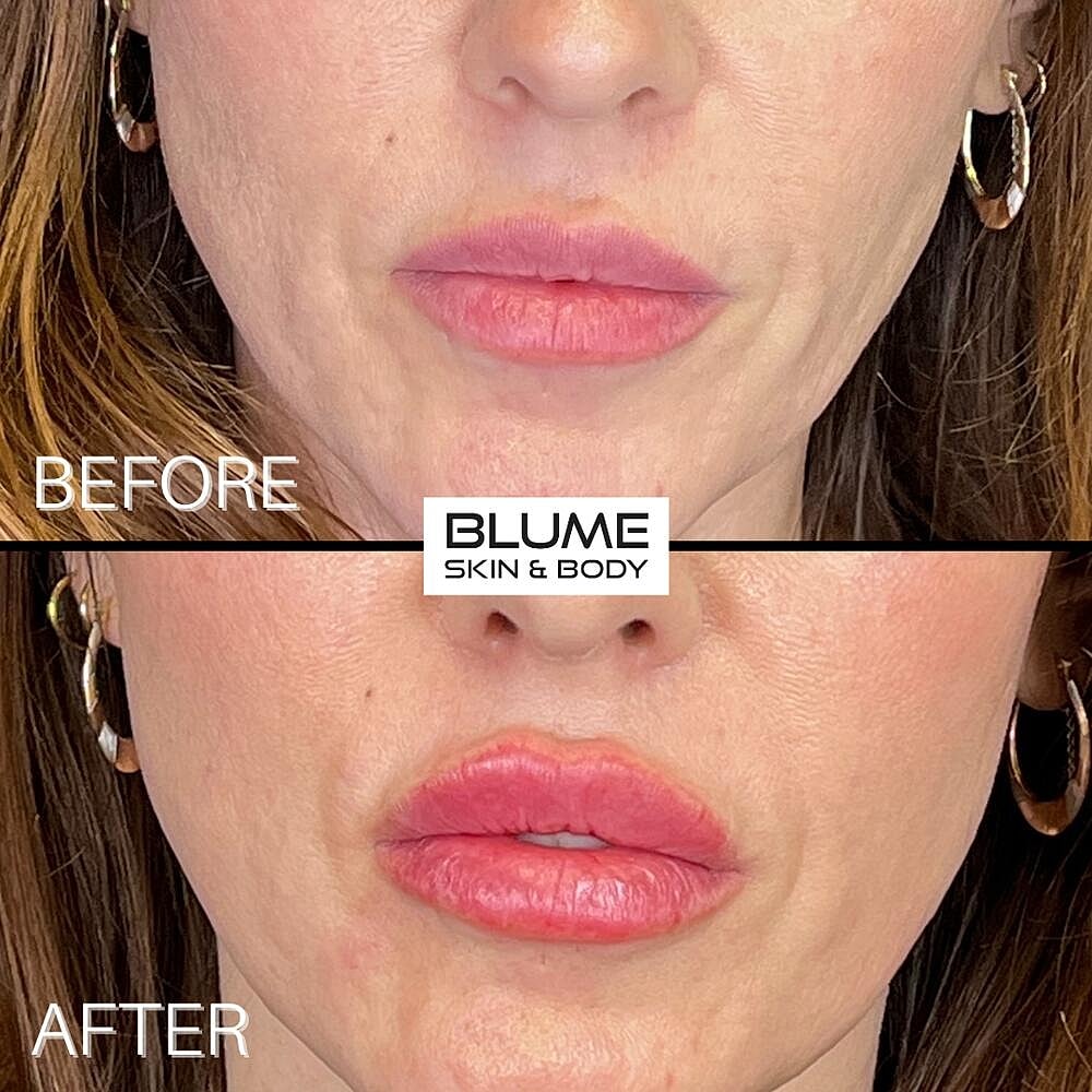 Dermal Fillers Before & After