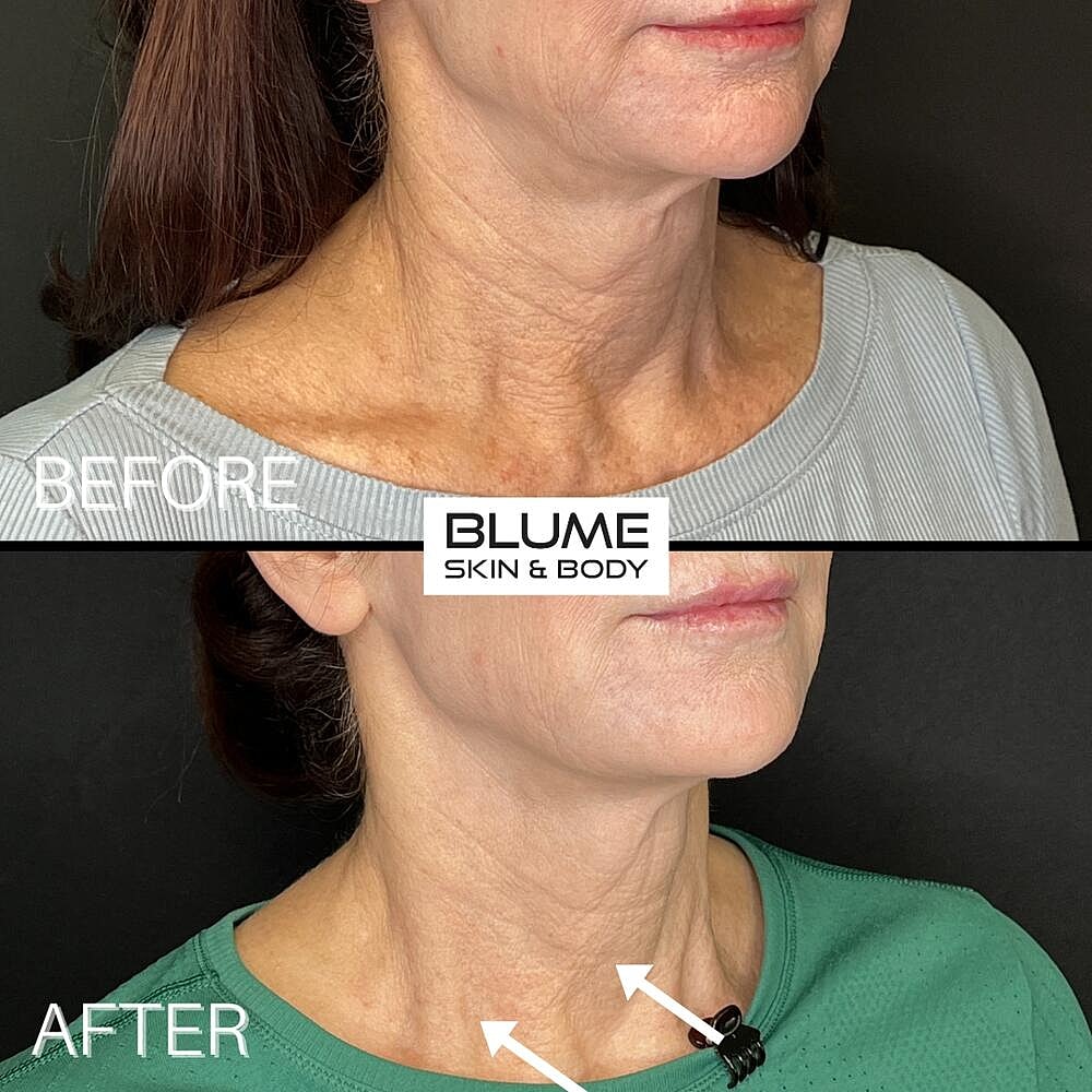 Dermal Fillers Before & After