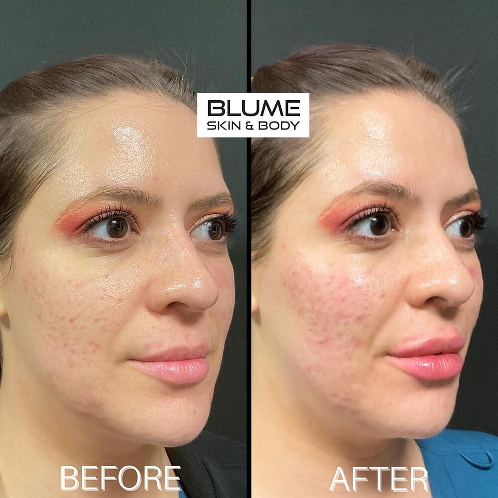 Dermal Fillers Before & After