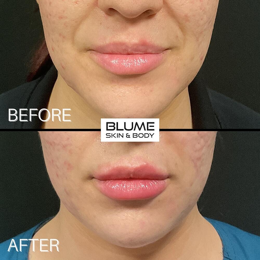 Dermal Fillers Before & After