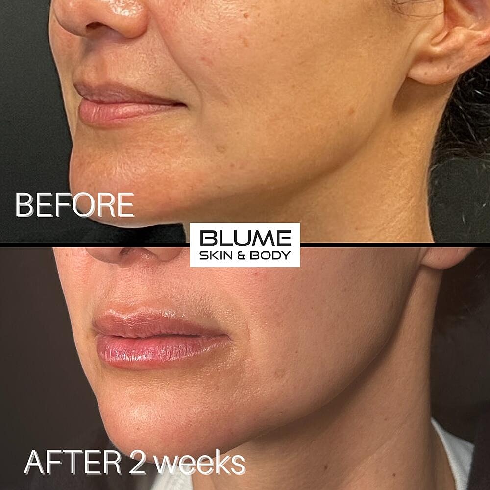 Dermal Fillers Before & After