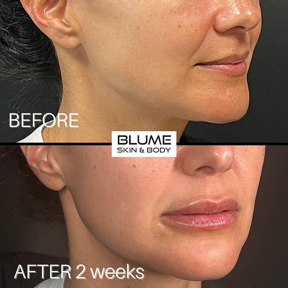 Dermal Fillers Before & After