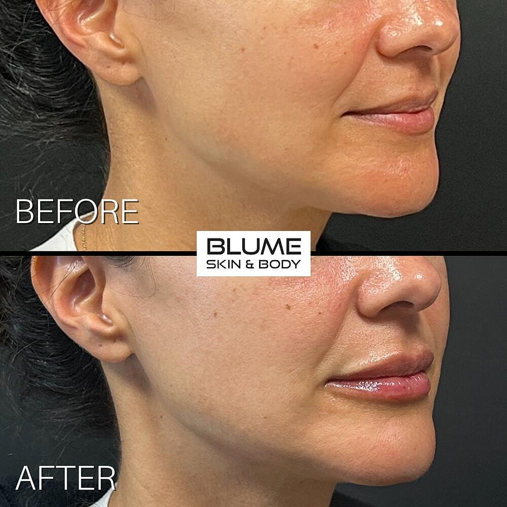 Dermal Fillers Before & After