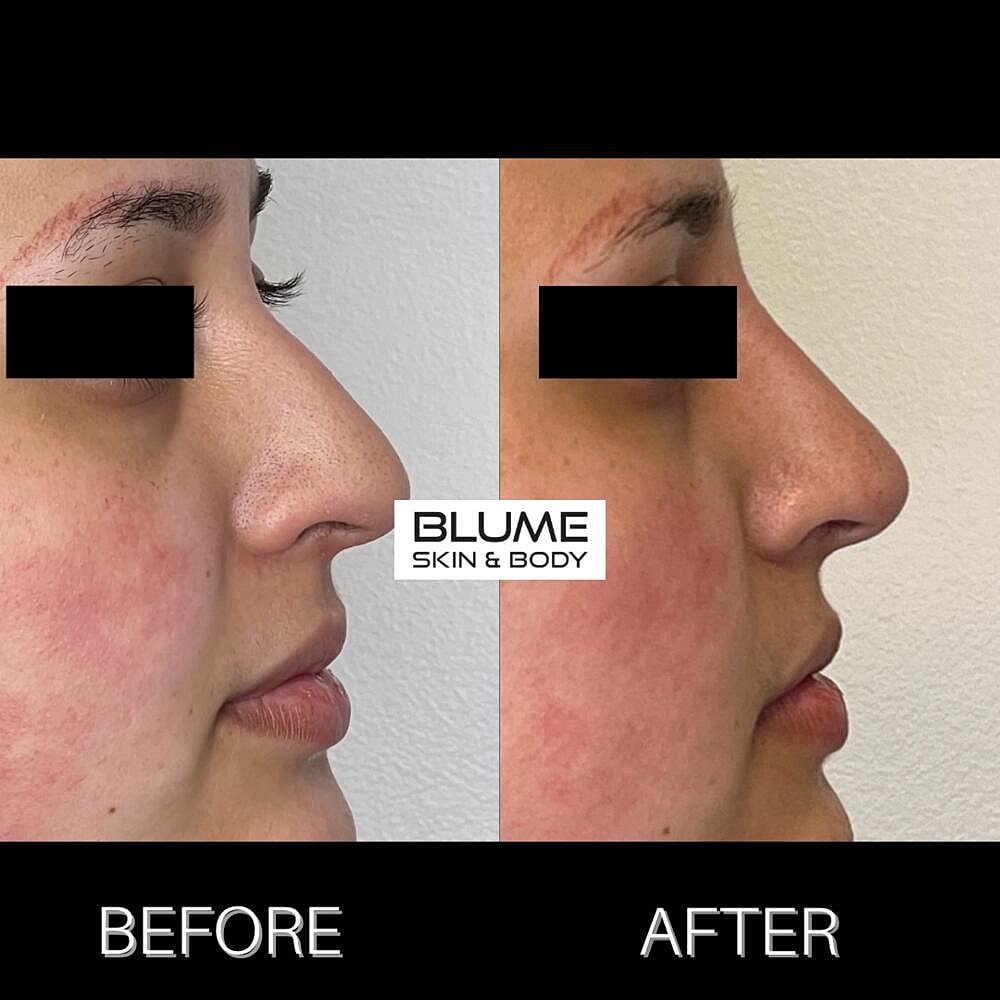 Dermal Fillers Before & After