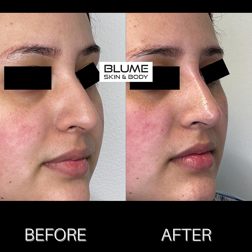 Dermal Fillers Before & After