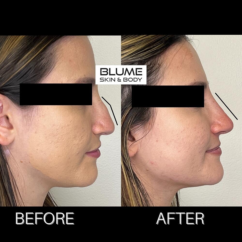 Dermal Fillers Before & After