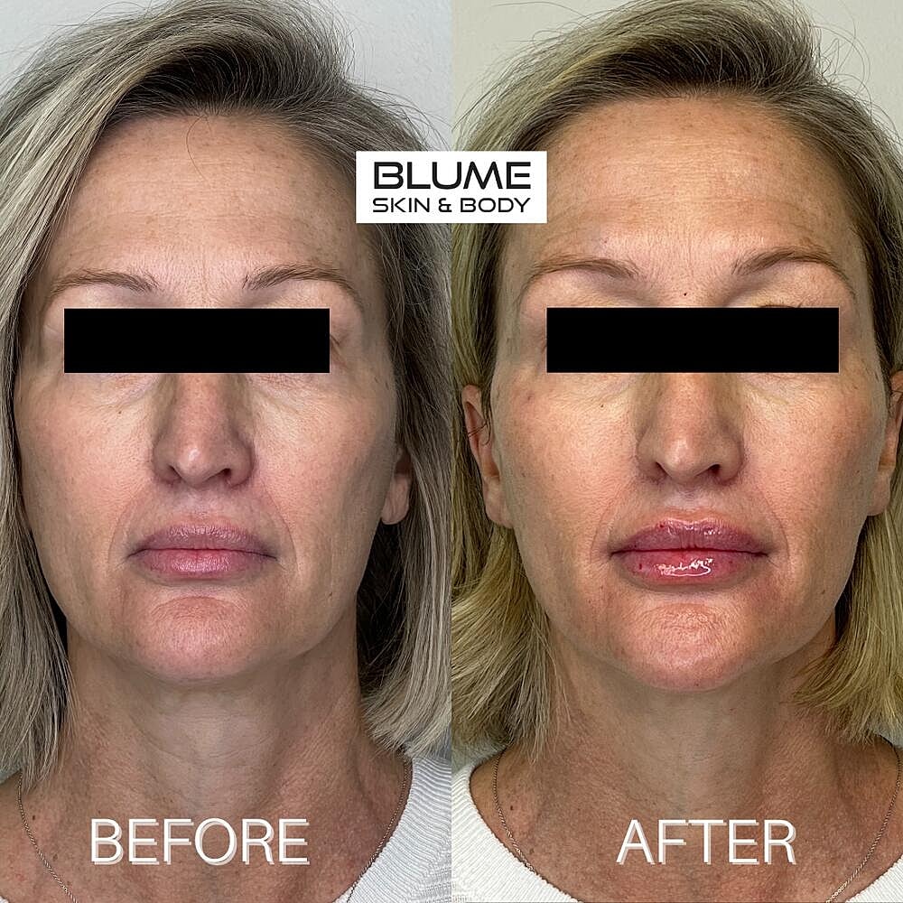 Dermal Fillers Before & After