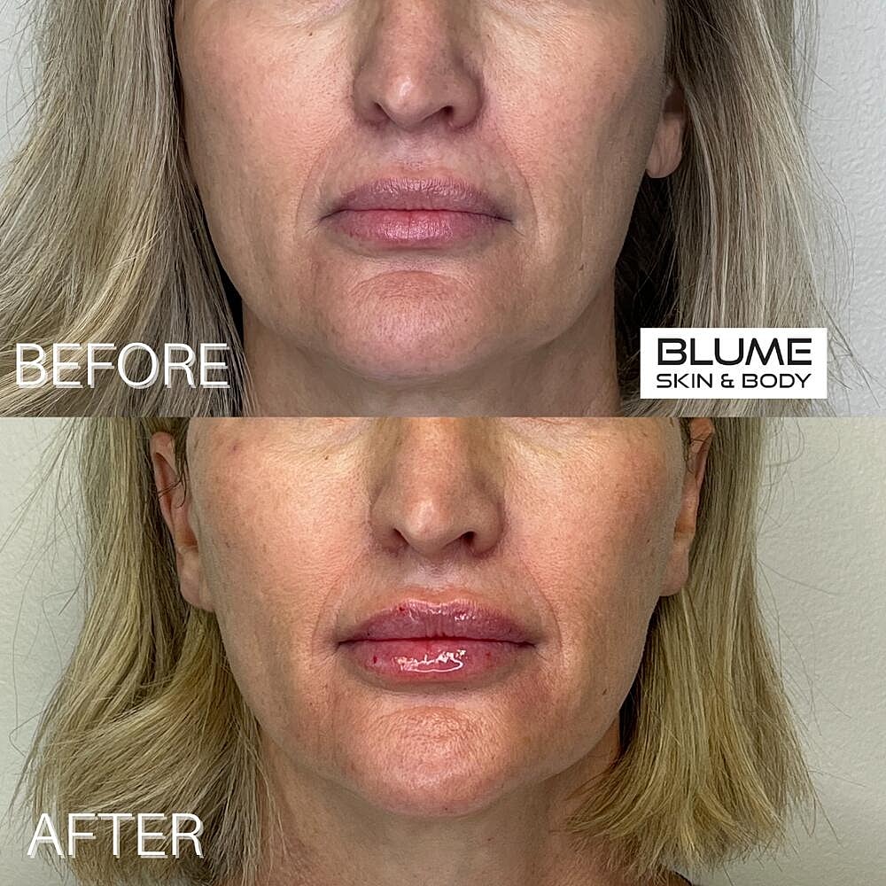 Dermal Fillers Before & After
