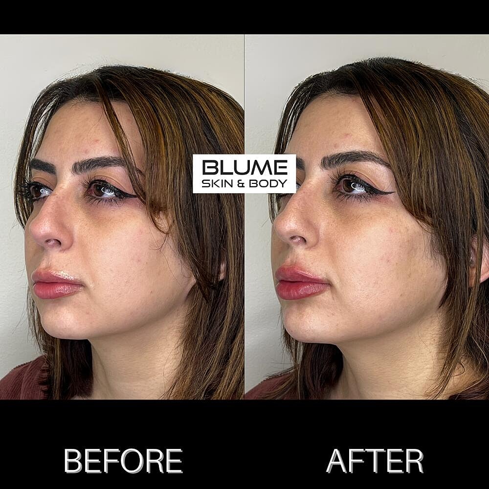 Dermal Fillers Before & After