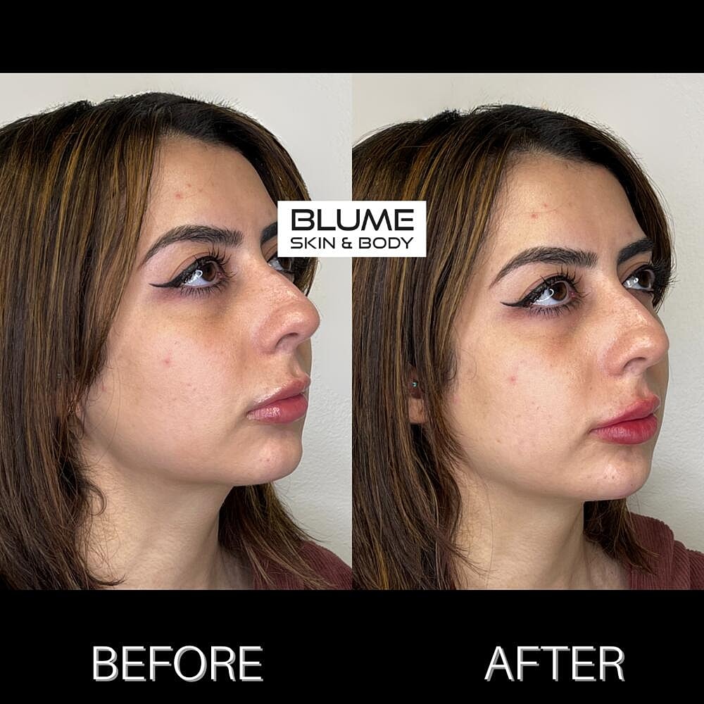 Dermal Fillers Before & After