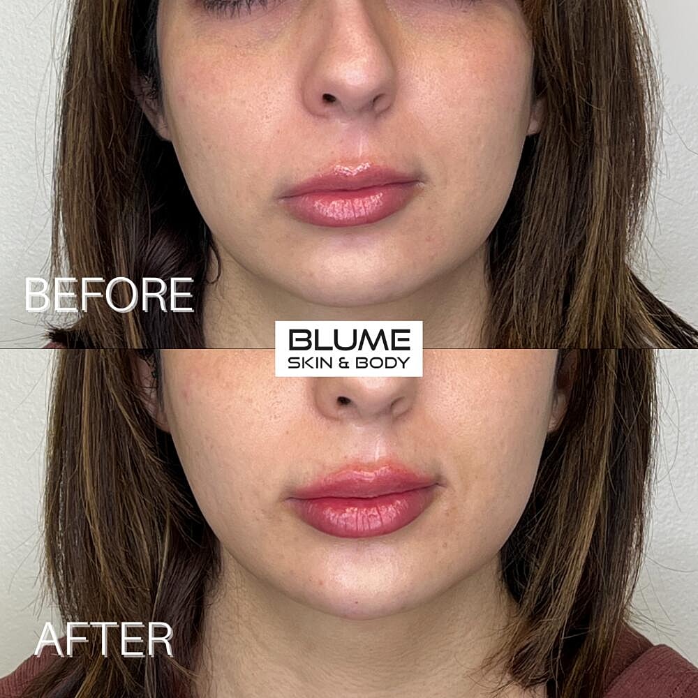 Dermal Fillers Before & After
