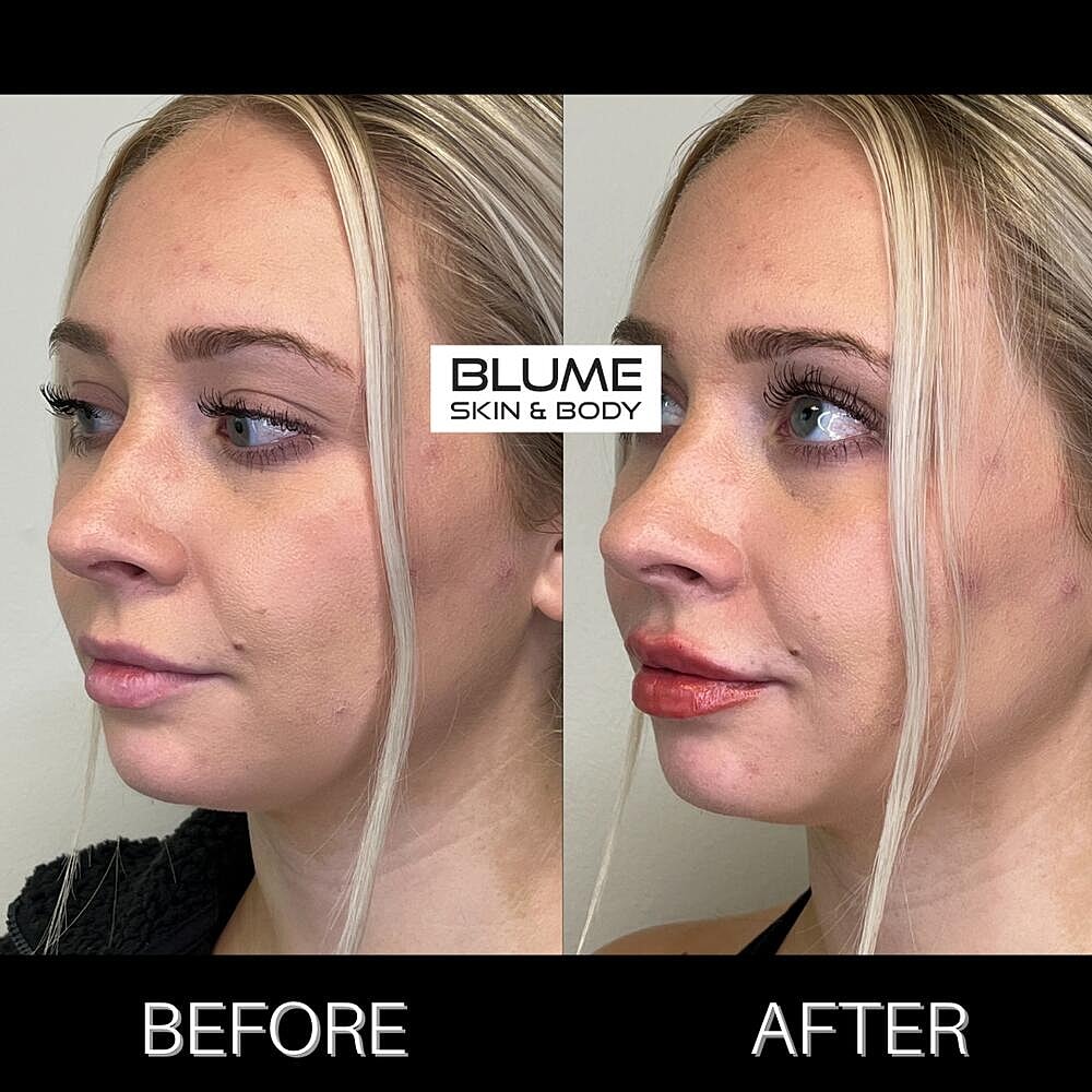 Dermal Fillers Before & After