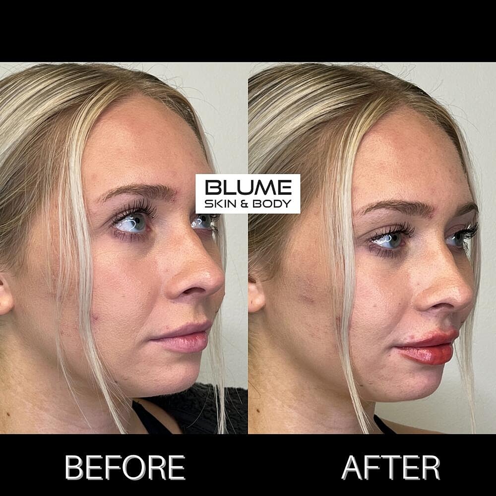 Dermal Fillers Before & After