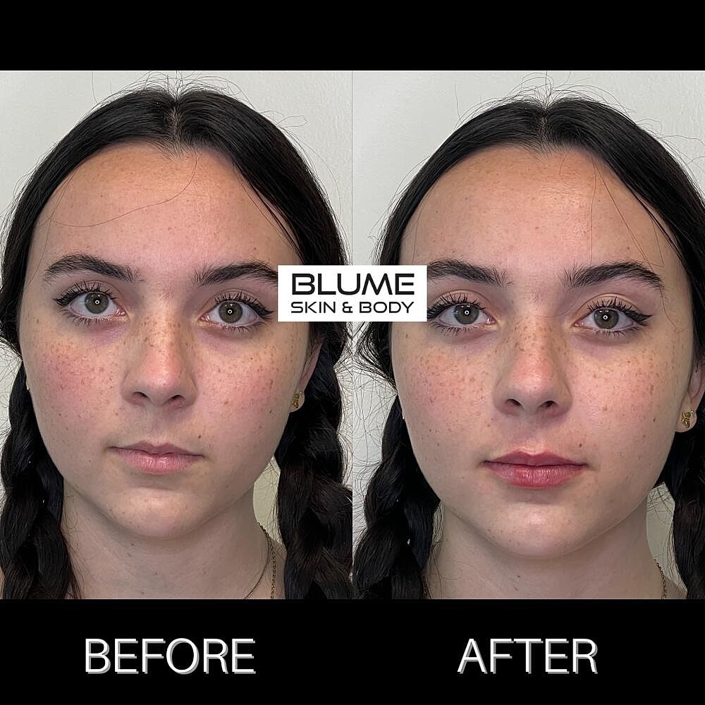 Dermal Fillers Before & After