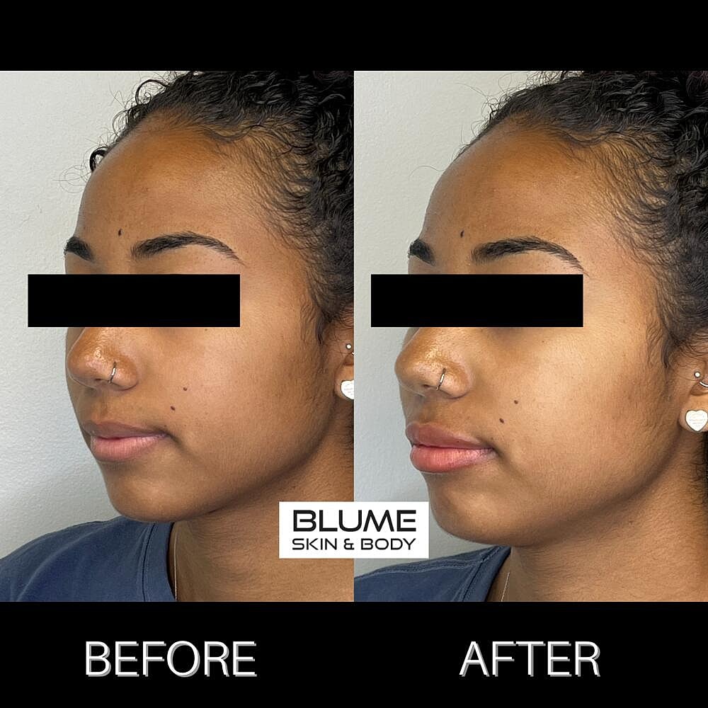 Dermal Fillers Before & After