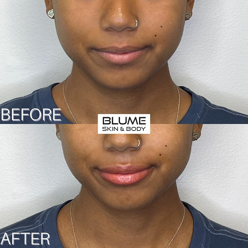 Dermal Fillers Before & After