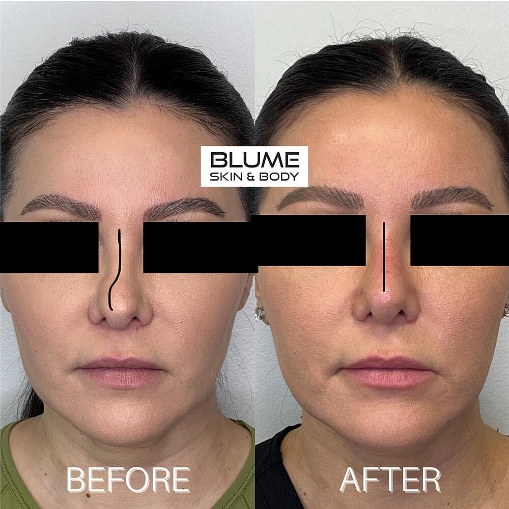 Dermal Fillers Before & After