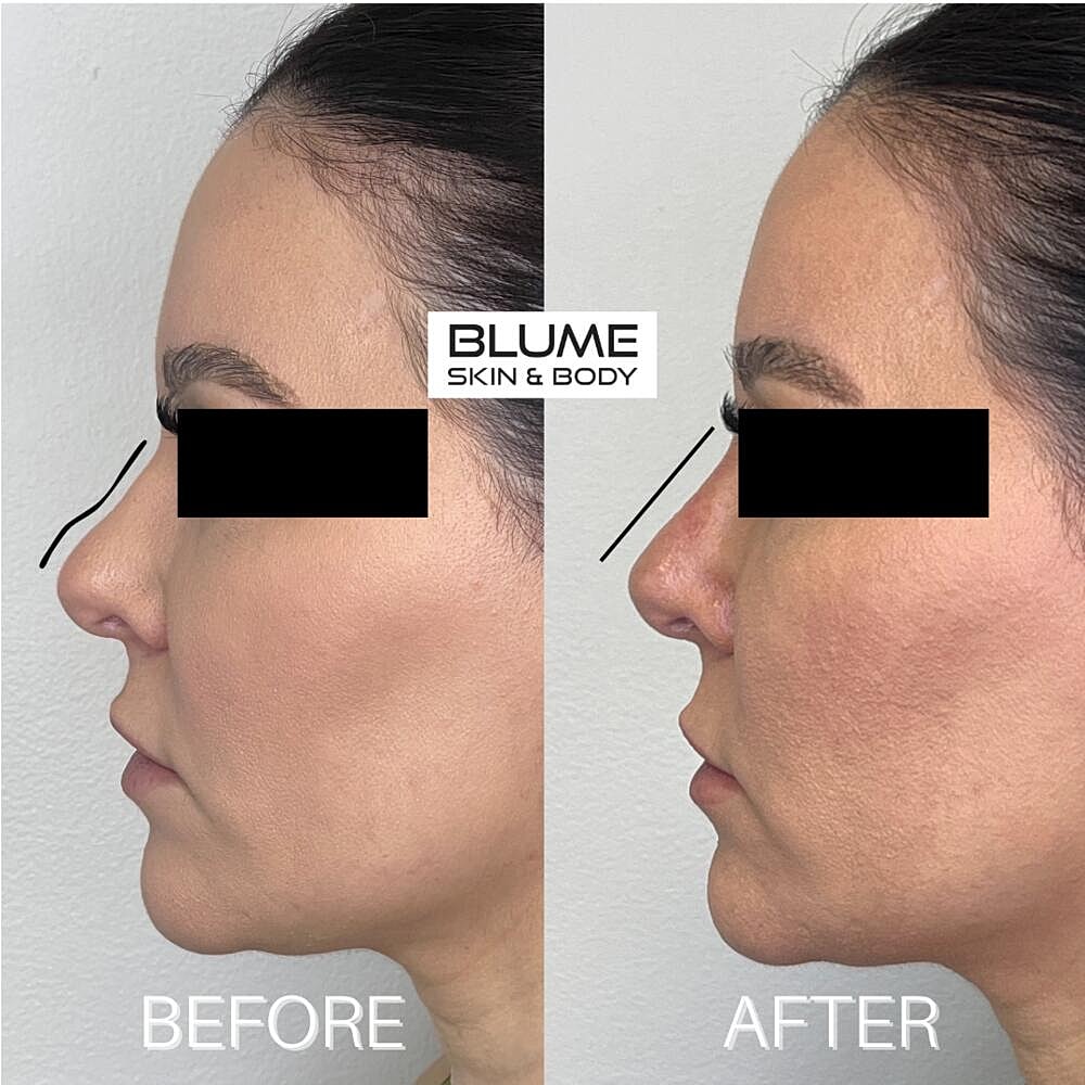 Dermal Fillers Before & After