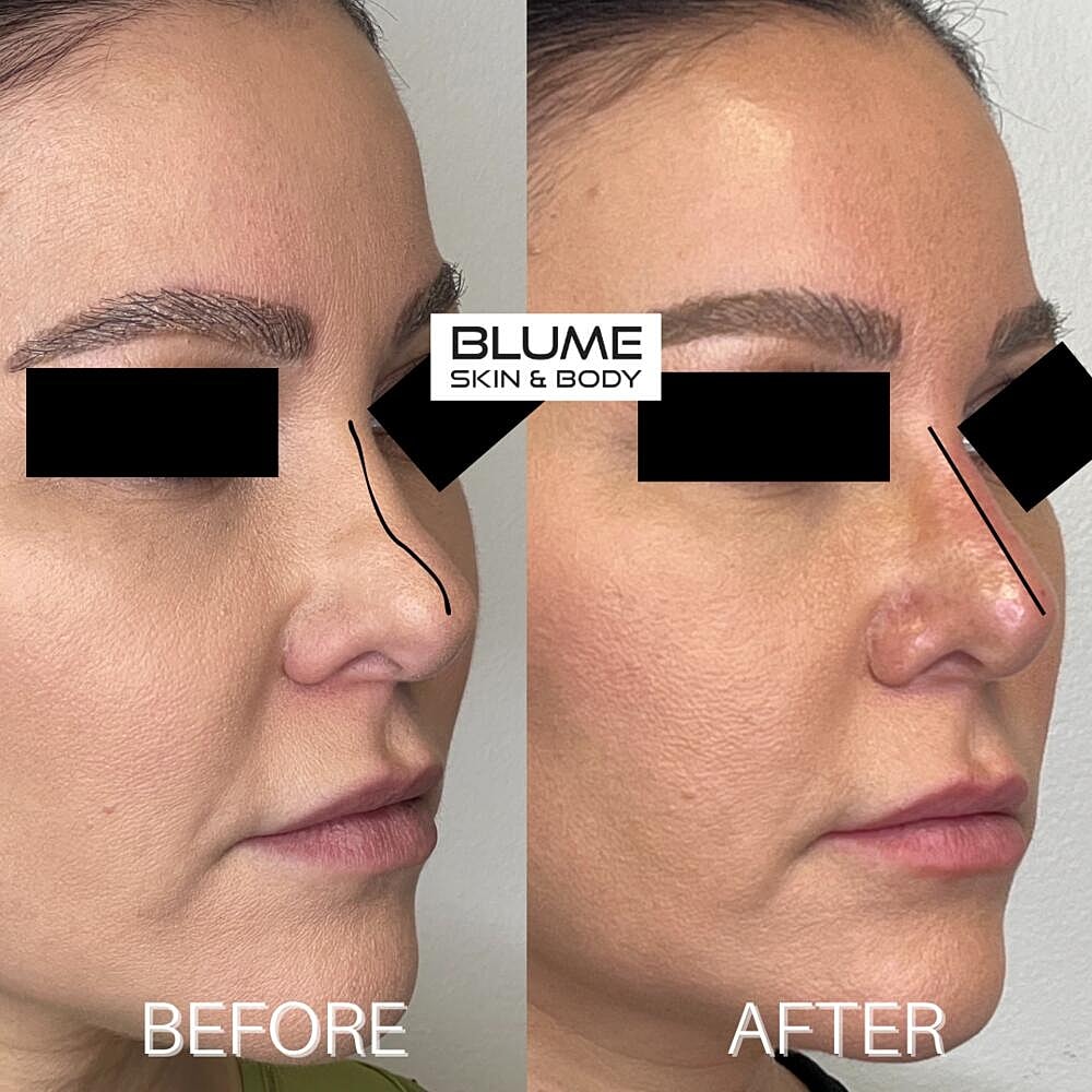 Dermal Fillers Before & After