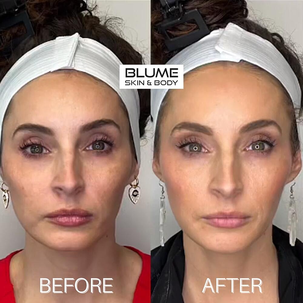 Dermal Fillers Before & After