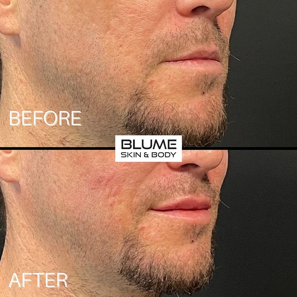 Dermal Fillers Before & After