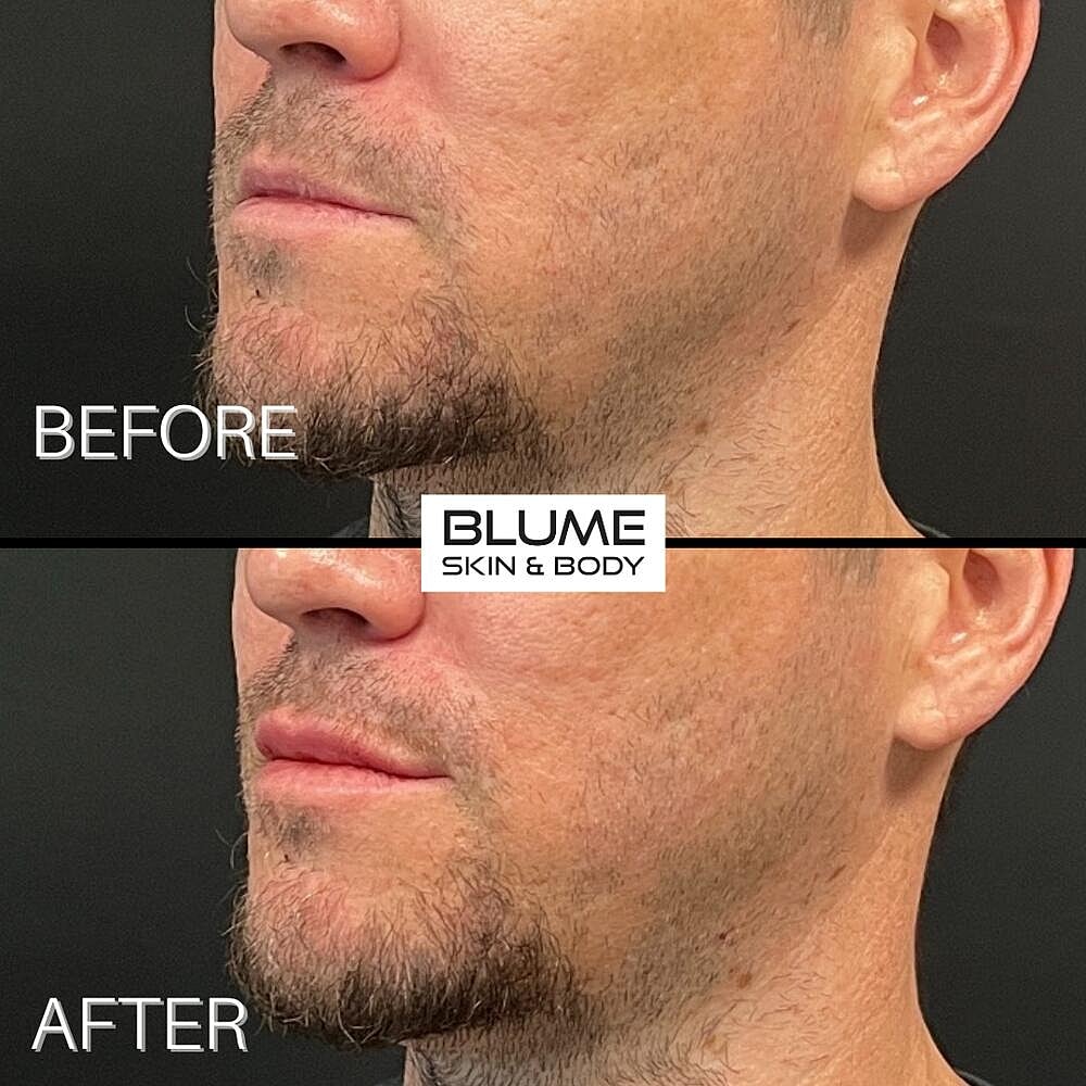 Dermal Fillers Before & After