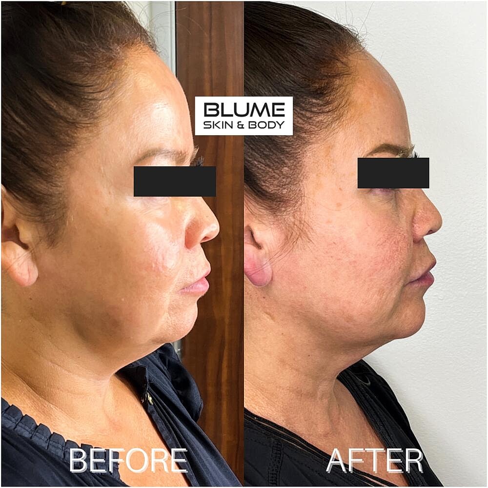 Dermal Fillers Before & After