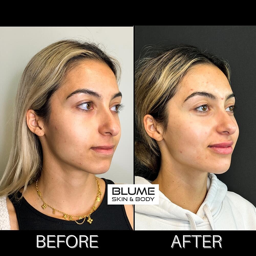 Dermal Fillers Before & After