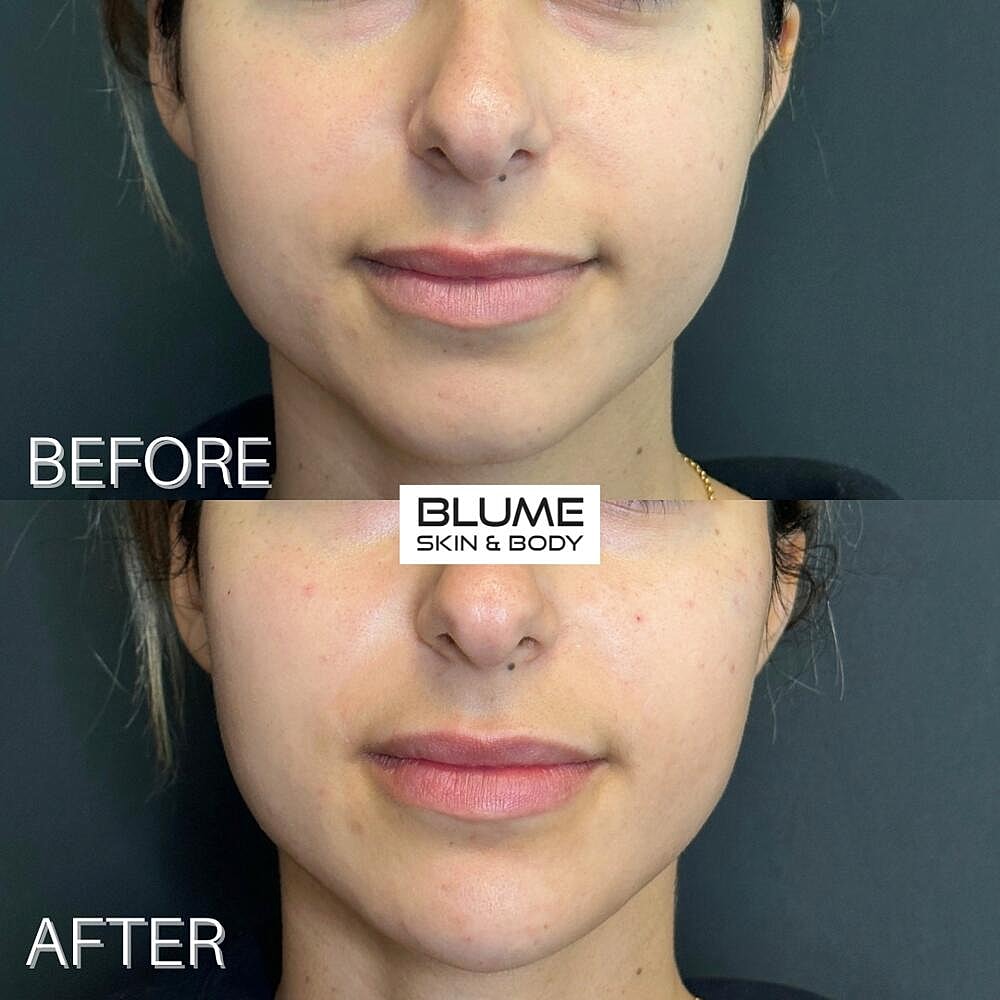 Dermal Fillers Before & After