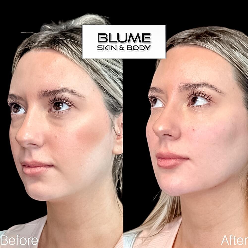 Dermal Fillers Before & After