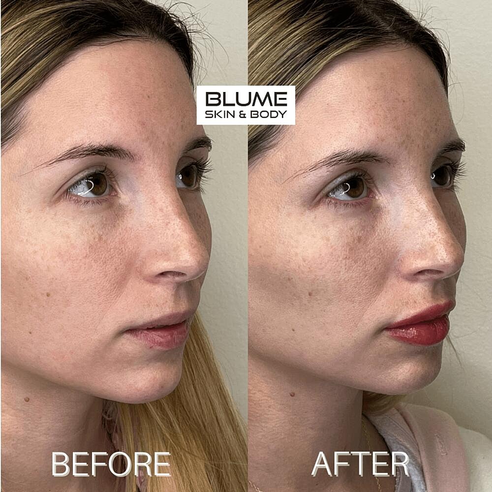 Dermal Fillers Before & After