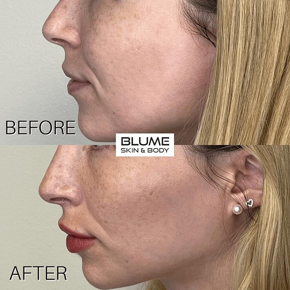 Dermal Fillers Before & After