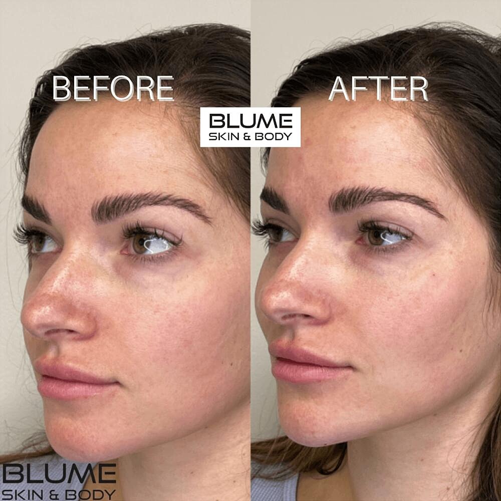 Dermal Fillers Before & After