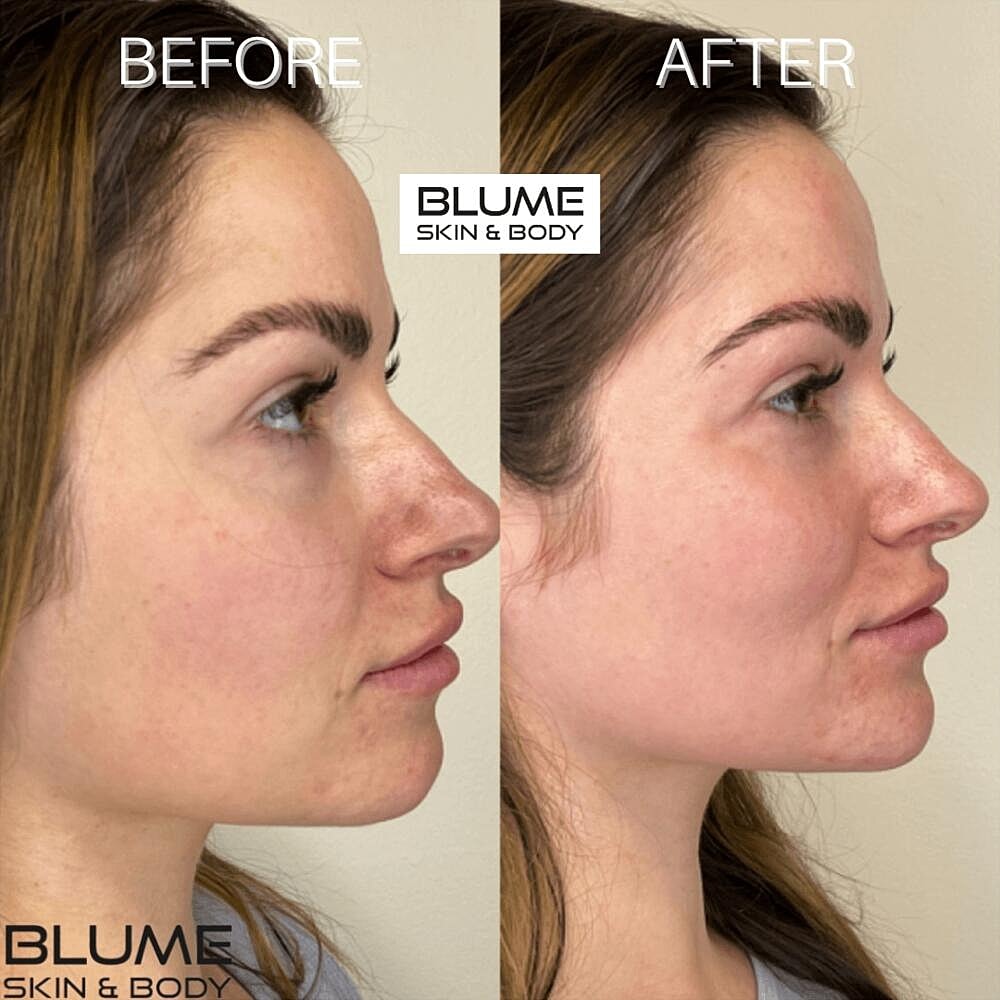 Dermal Fillers Before & After