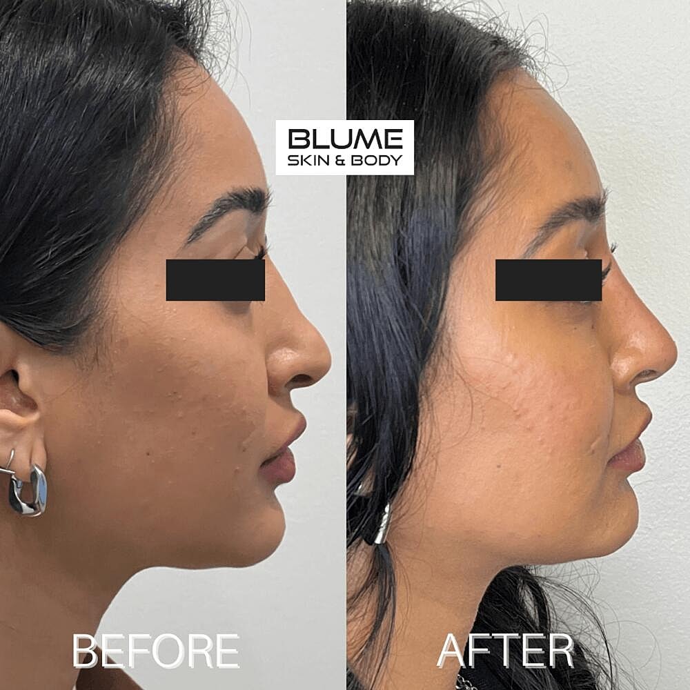 Dermal Fillers Before & After