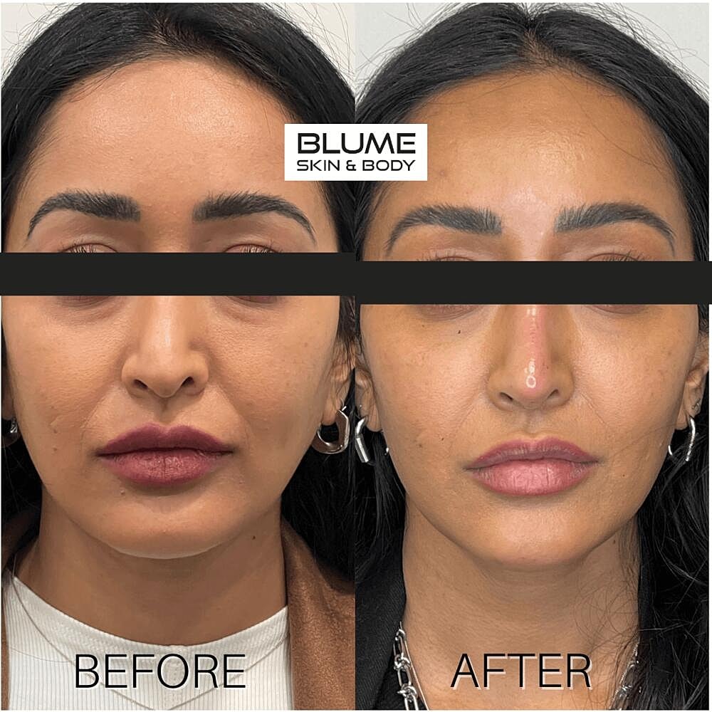 Dermal Fillers Before & After
